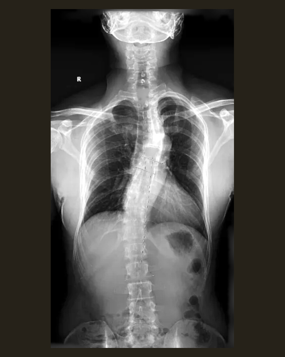 Spinal radiograph showing a scoliotic curve